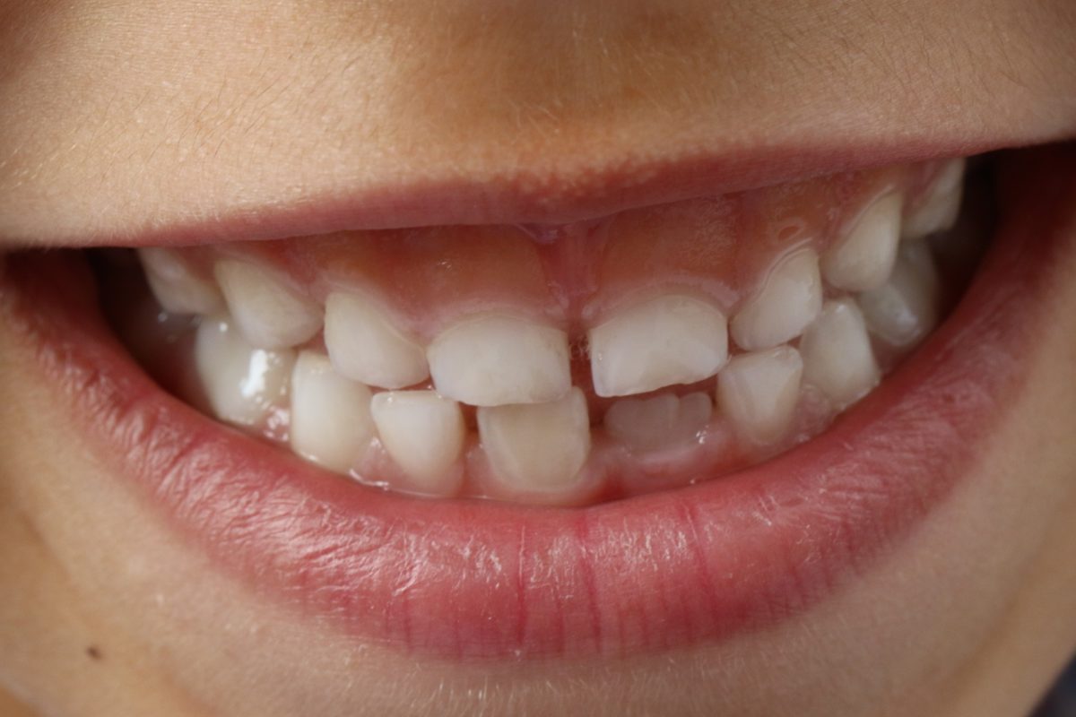 Les anomalies dentaires les plus fréquentes